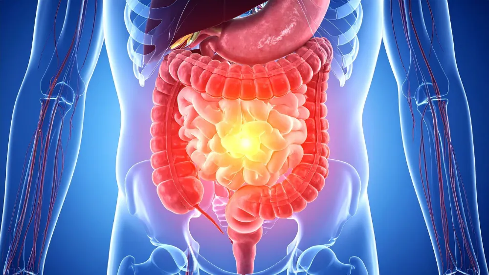 intestino permeable