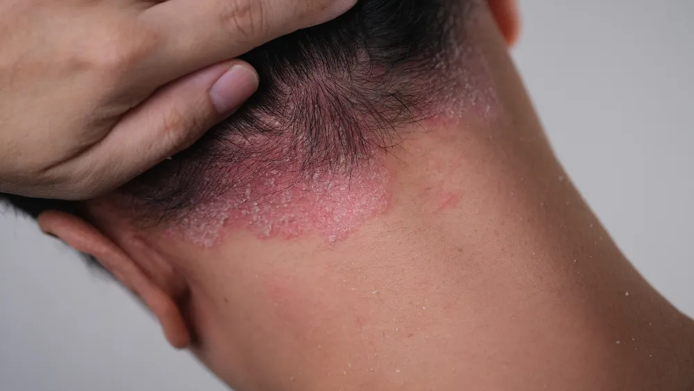 psoriasis