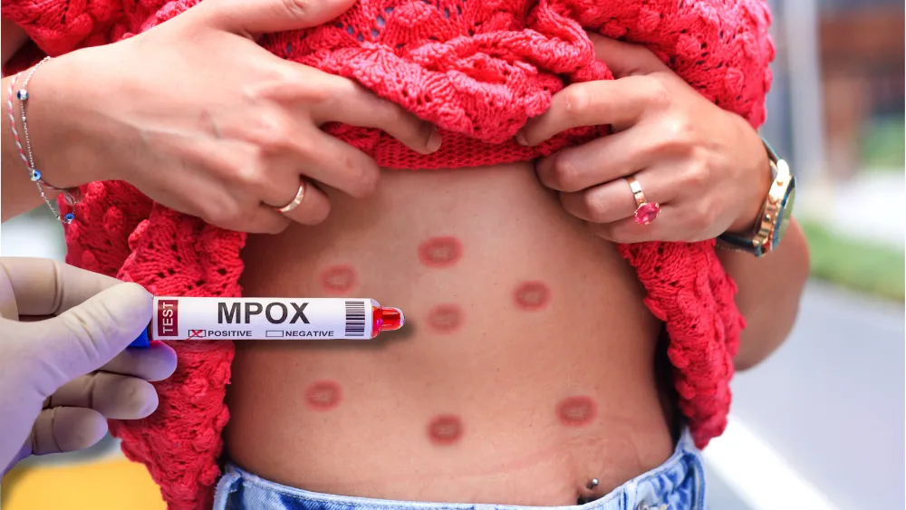 mpox