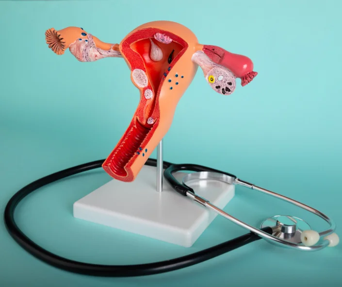 Qué es la endometriosis y por qué afecta la fertilidad