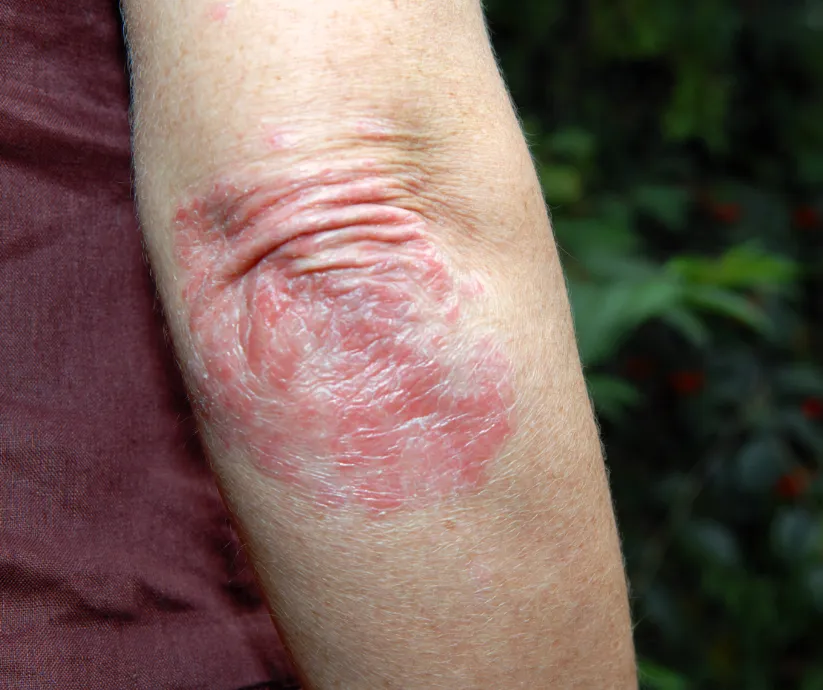 psoriasis2