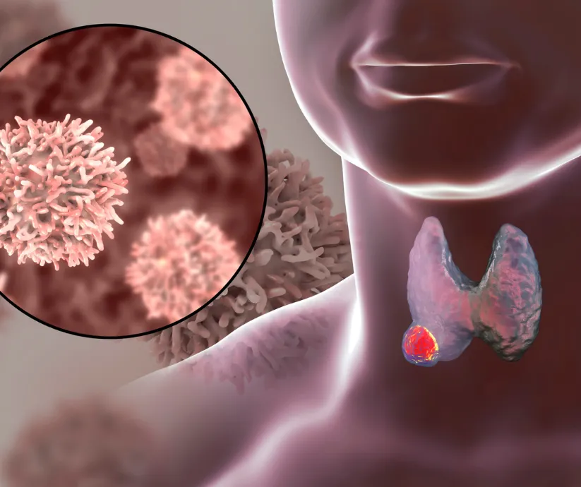 tiroides cancer