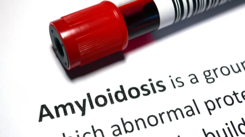 amiloidosis 2